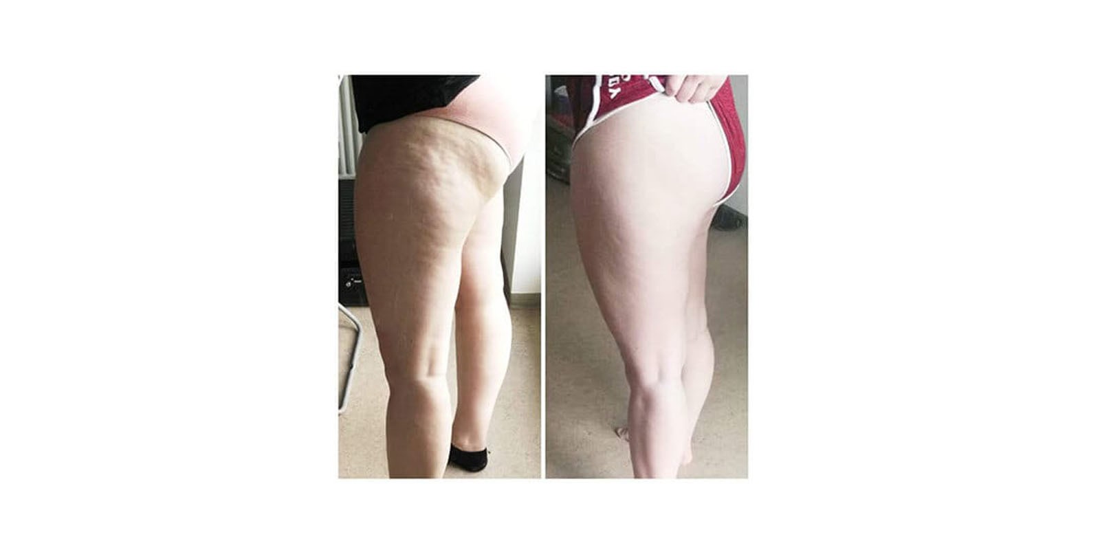 My Cellulite solution Results